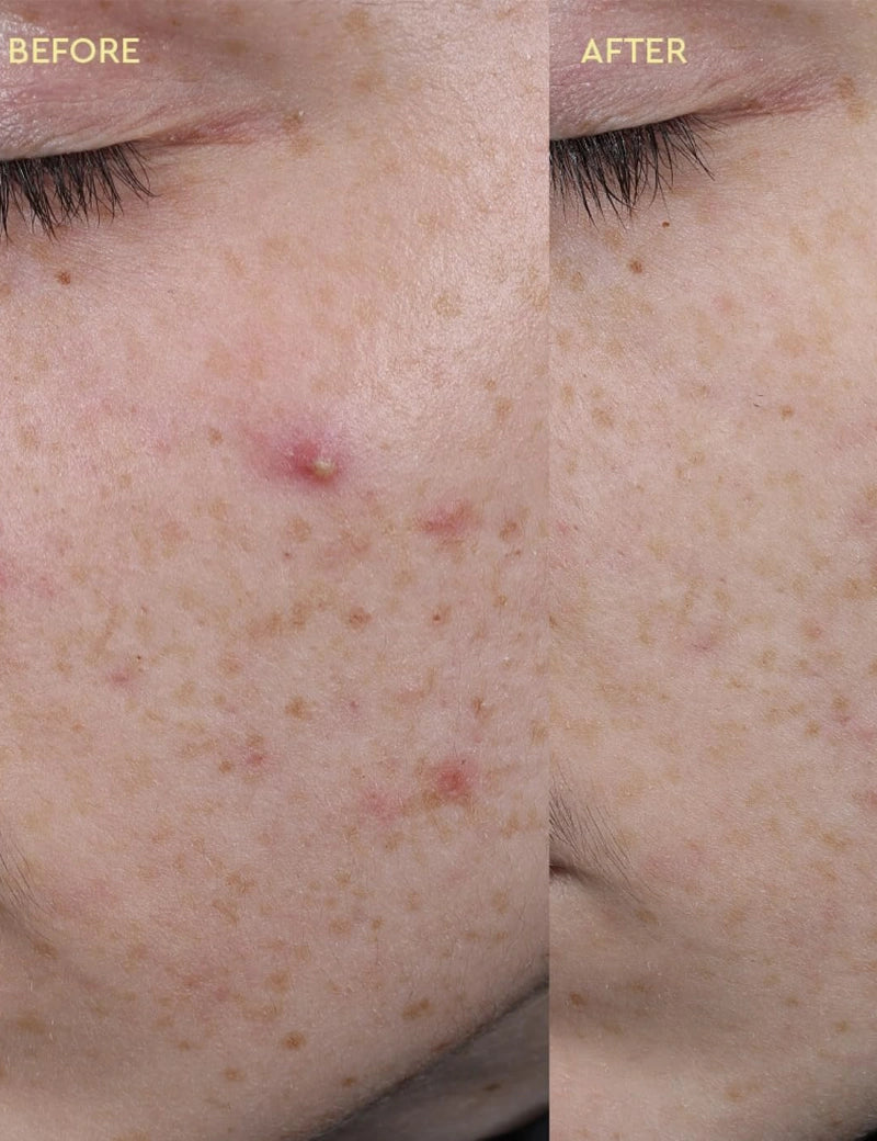 BLEMISH CLEARING PASTE - Tratamiento Anti-imperfecciones