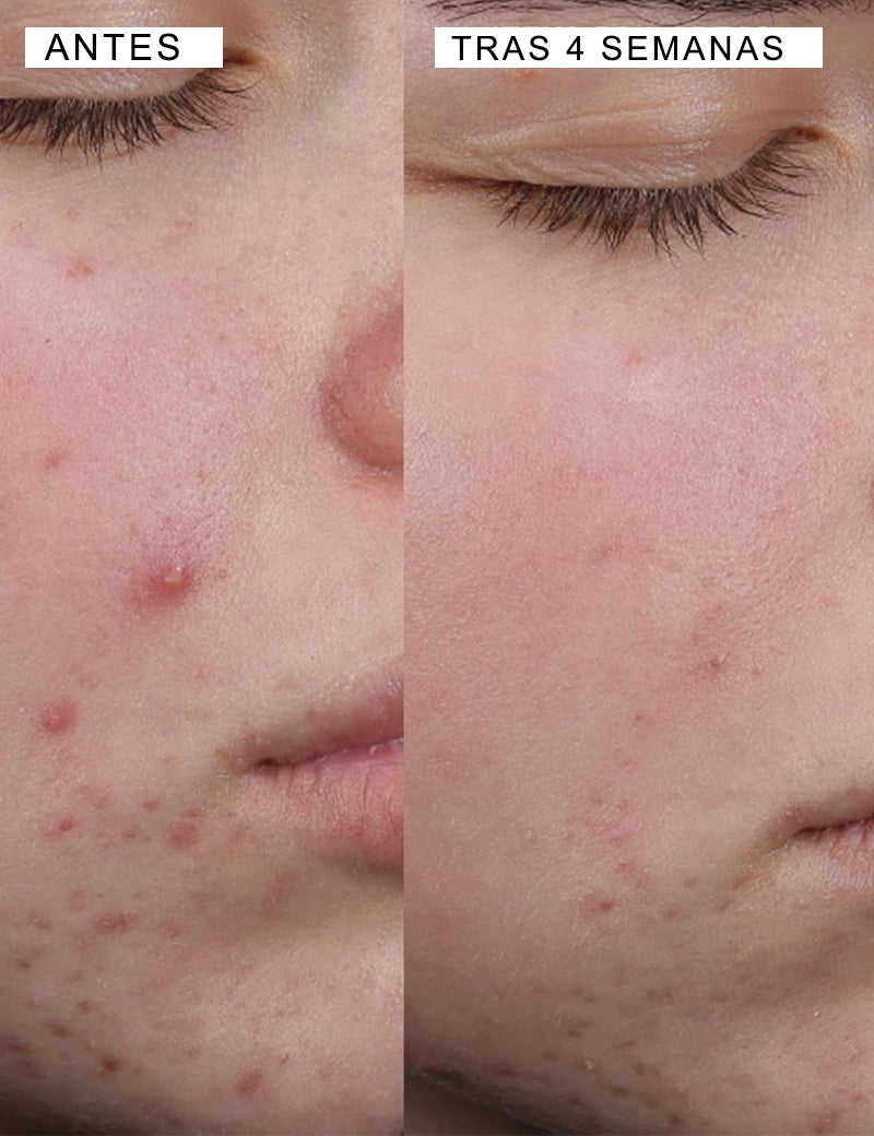 BLEMISH CLEARING CLEANSER - Gel Limpiador Anti-imperfecciones