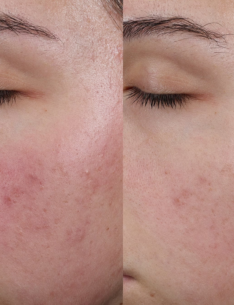 BLEMISH CONTROL MOISTURISER - Crema Hidratante Anti-imperfecciones