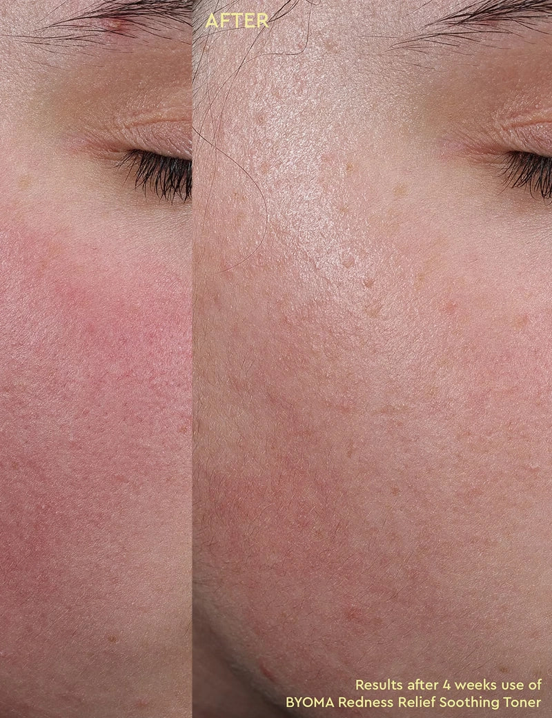 BLEMISH SOOTHING TONER - Tónico Calmante Antirojeces